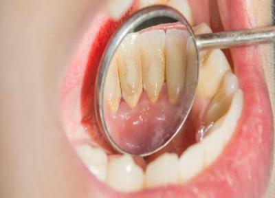 آنچه باید درباره کلسیفیکاسیون دندان بدانیم